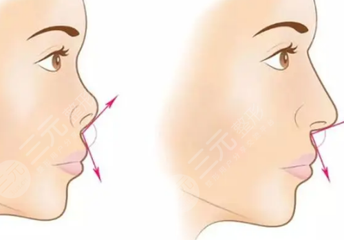 墊鼻基底前后對比