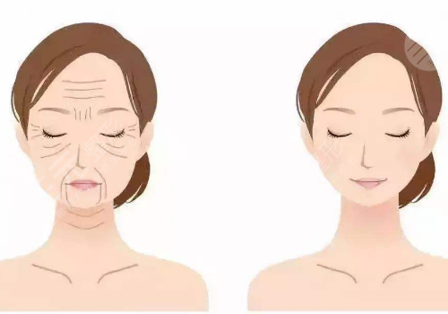 上海九院拉皮手術(shù)費用多少?