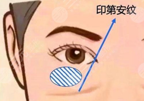 印第安紋和淚溝的區(qū)別是什么？