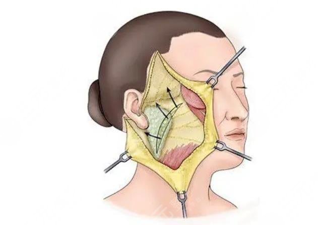 雙矢量提升術(shù)和筋膜懸吊術(shù)哪個(gè)好
