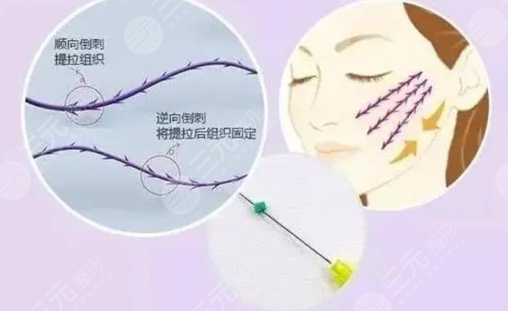 雙矢量提升術(shù)和筋膜懸吊術(shù)哪個(gè)好