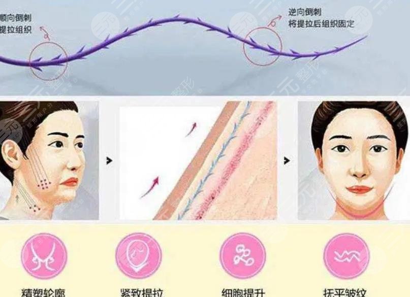 雙矢量提升術(shù)和筋膜懸吊術(shù)哪個(gè)好