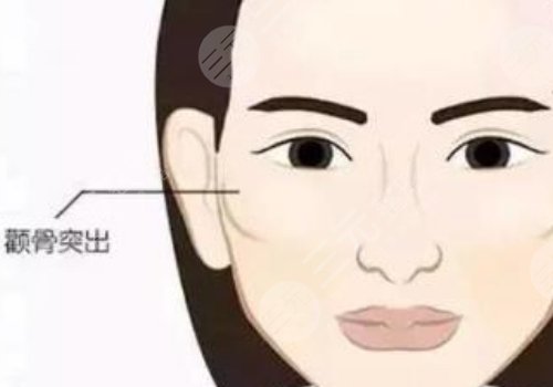 顴骨高怎么改良臉型？