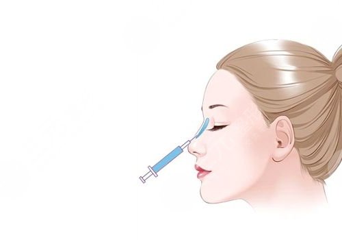 微調(diào)整形都有什么項(xiàng)目？