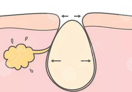 面頰毛孔粗大,怎么辦