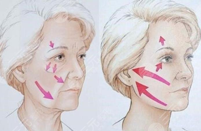 丁杰做拉皮手術(shù)案例