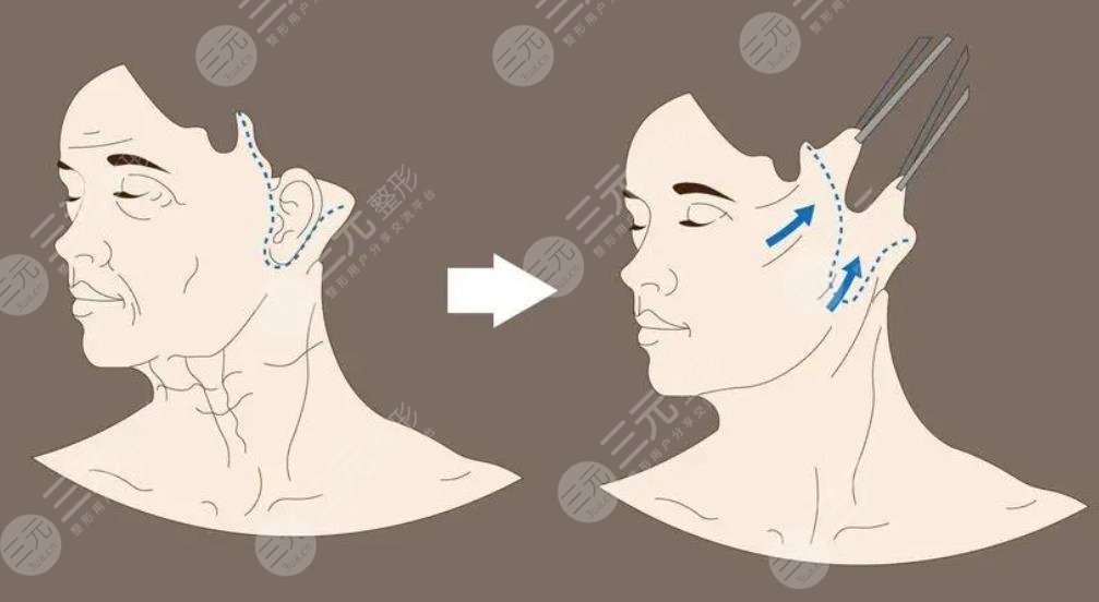 雙矢量組織復位術(shù)