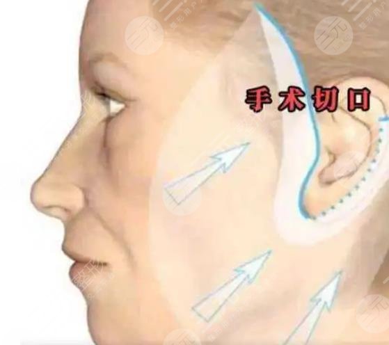 李曉東拉皮手術案例