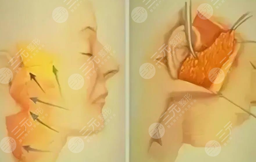 李曉東拉皮手術案例