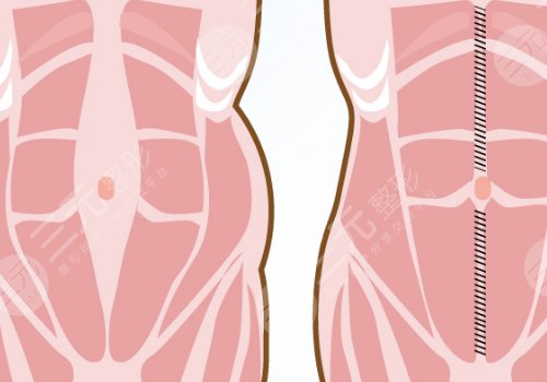 腹部拉皮手術(shù)多久能恢復正常？