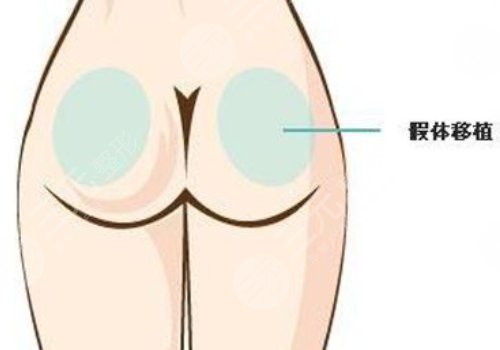 假體豐臀需要多少錢？