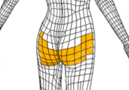 假體豐臀需要多少錢？