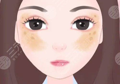 臉頰兩側(cè)長(zhǎng)斑是什么原因？