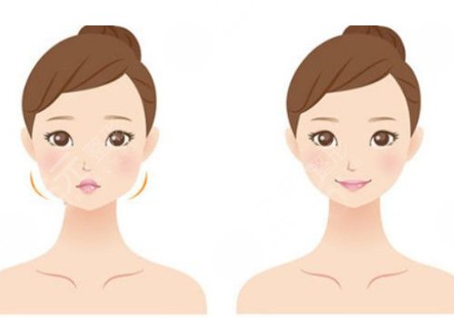 內(nèi)輪廓固定提升能保持多久時間？