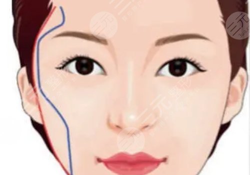 顴弓吸脂有什么后遺癥？