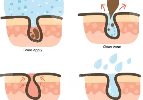 t區(qū)出油毛孔粗大怎么辦？