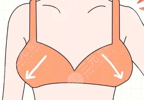 胸型外擴(kuò)怎么矯正