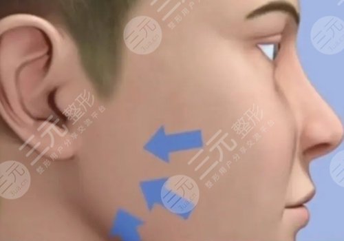 外輪廓固定提升有哪些手術(shù)方案？