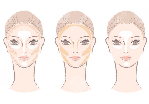 外輪廓固定提升有哪些手術(shù)方案？