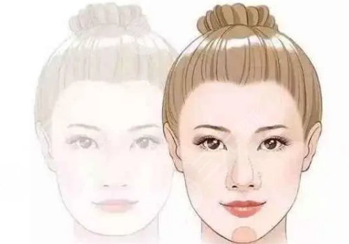 外輪廓提升需要幾支玻尿酸？