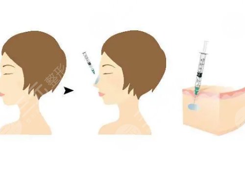 外輪廓提升需要幾支玻尿酸？