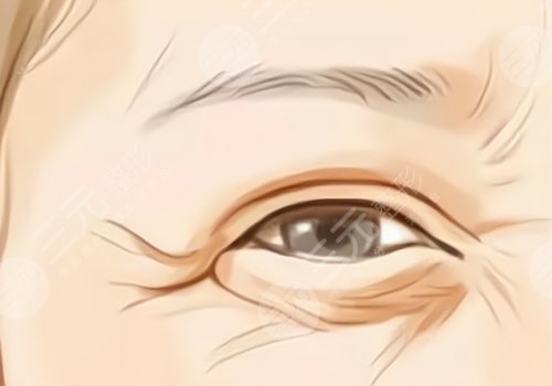 薇旖美可以注射眼部周圍的皺紋不？