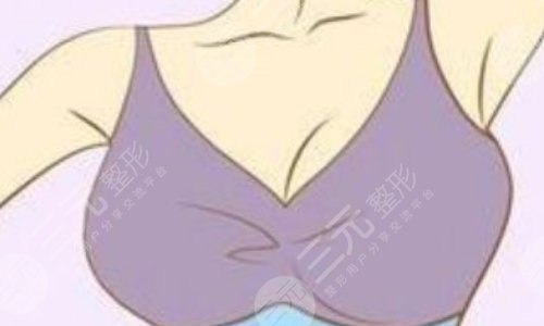 自體隆胸可以保持幾年？