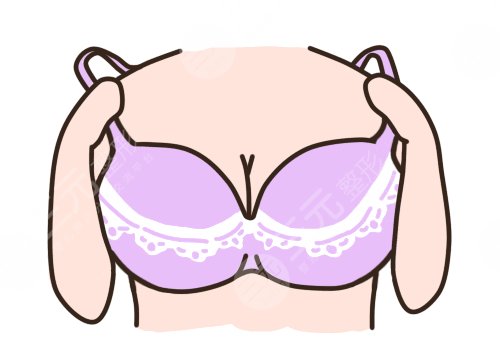 自體隆胸可以保持幾年？