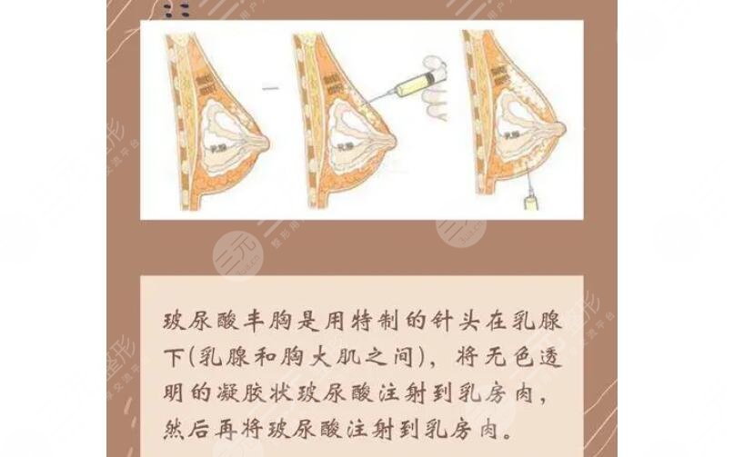 注射玻尿酸豐胸有危險嗎？