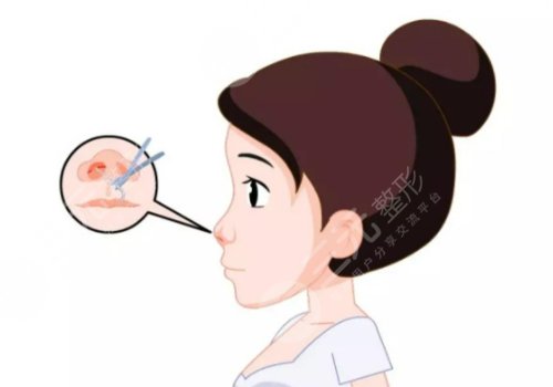 整鼻子鼻翼縮小多少錢