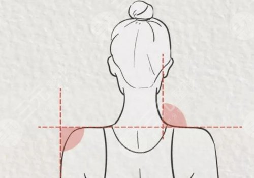 做直角肩多少錢？