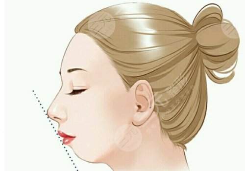 下巴后縮是什么原因造成的？