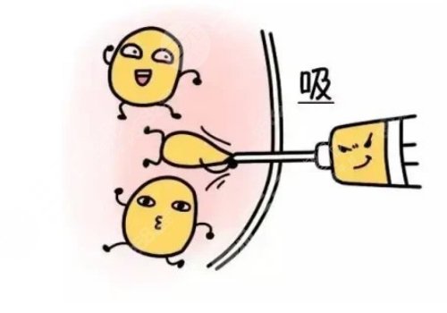 腰腹環(huán)吸抽脂需要多久恢復期