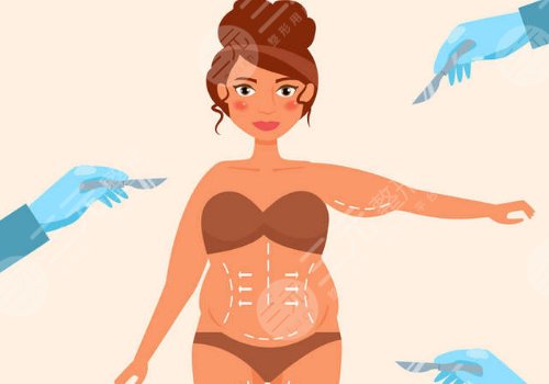 腰腹環(huán)吸抽脂需要多久恢復期