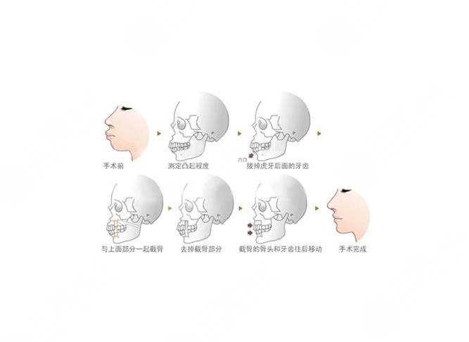 下巴后縮矯正多少錢