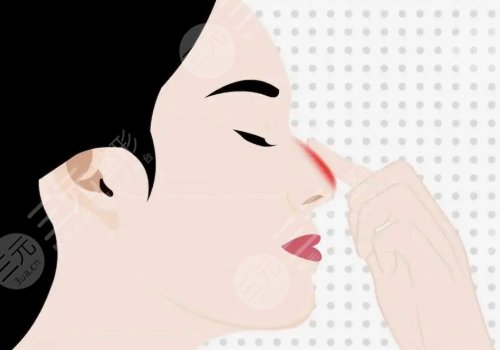 鼻子修復必須要滿3個月嗎？