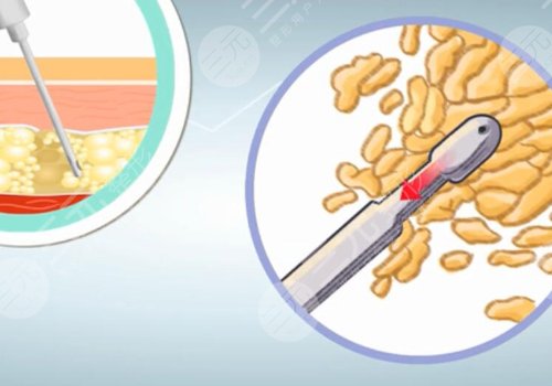 人魚體雕和普通吸脂區(qū)別