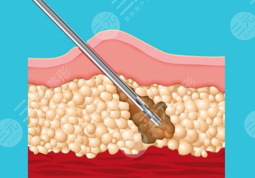 人魚體雕和普通吸脂區(qū)別