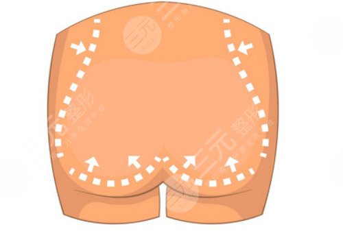 媽媽臀吸脂多久可以恢復(fù)？