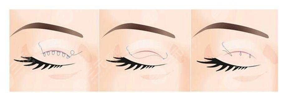 雙眼皮分為哪幾種做法？