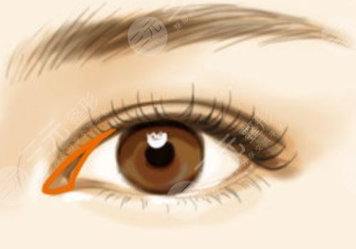 廣州顏玲雙眼皮案例