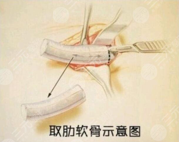 綜合鼻和肋骨鼻有什么區(qū)別?