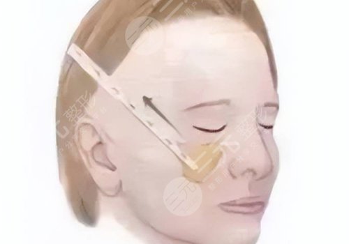 微拉美是什么整容項(xiàng)目