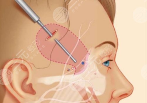 微拉美是什么整容項(xiàng)目