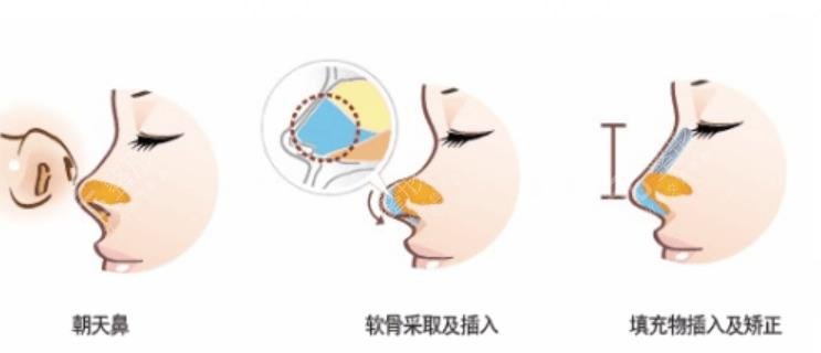 朝天鼻整形手術.jpg