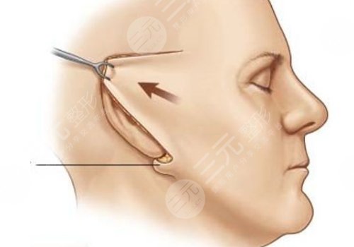 廣州陳兵拉皮手術效果如何？