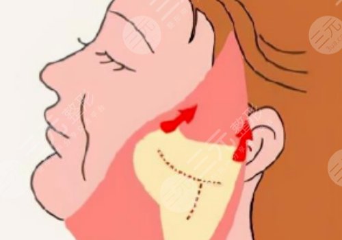 廣州陳兵拉皮手術效果如何