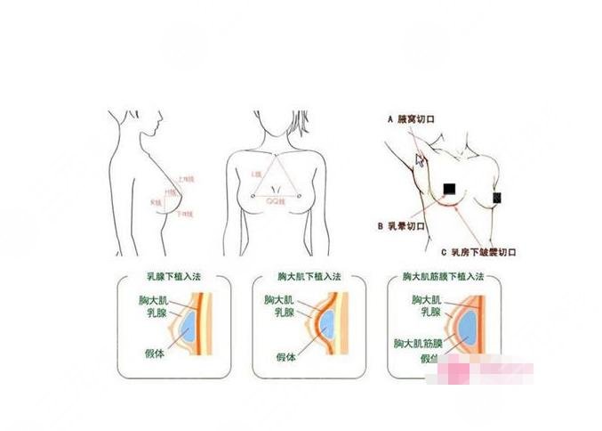 中山一院整形外科乳房再造多少錢