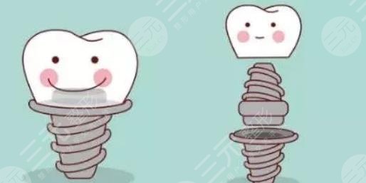 北京大學(xué)第三醫(yī)院種牙案例