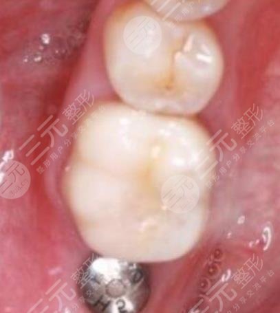 陸永健醫(yī)生種植案例